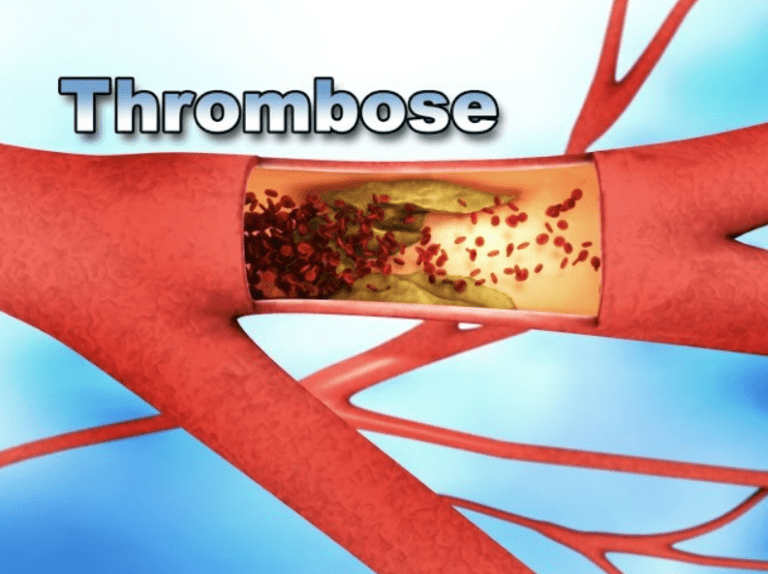 Thrombose Ursachen und Risikofaktoren
